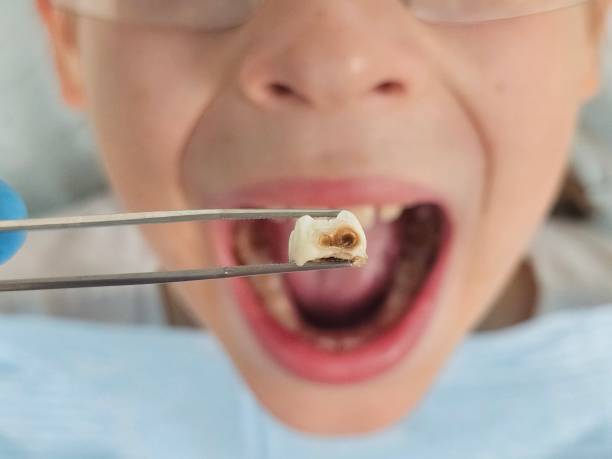 Best Emergency Dental Care for Broken or Chipped Teeth in , PA